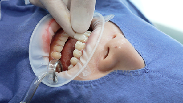 Veneer Bonding Stage