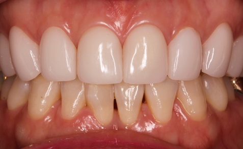 Long-term result