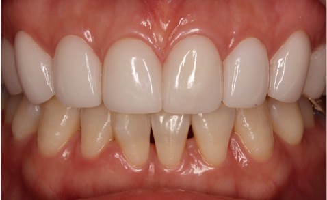 Long-term result