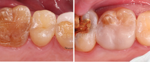 Damaged Molar Teeth
