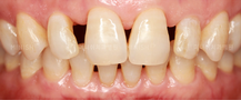 Gapped Teeth