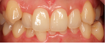 Misaligned Teeth
