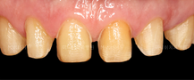 Shaved Teeth