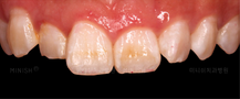 Long or Short Teeth