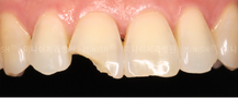 Damaged Teeth
