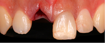 Missing Teeth
