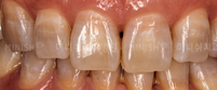 Discoloured Teeth