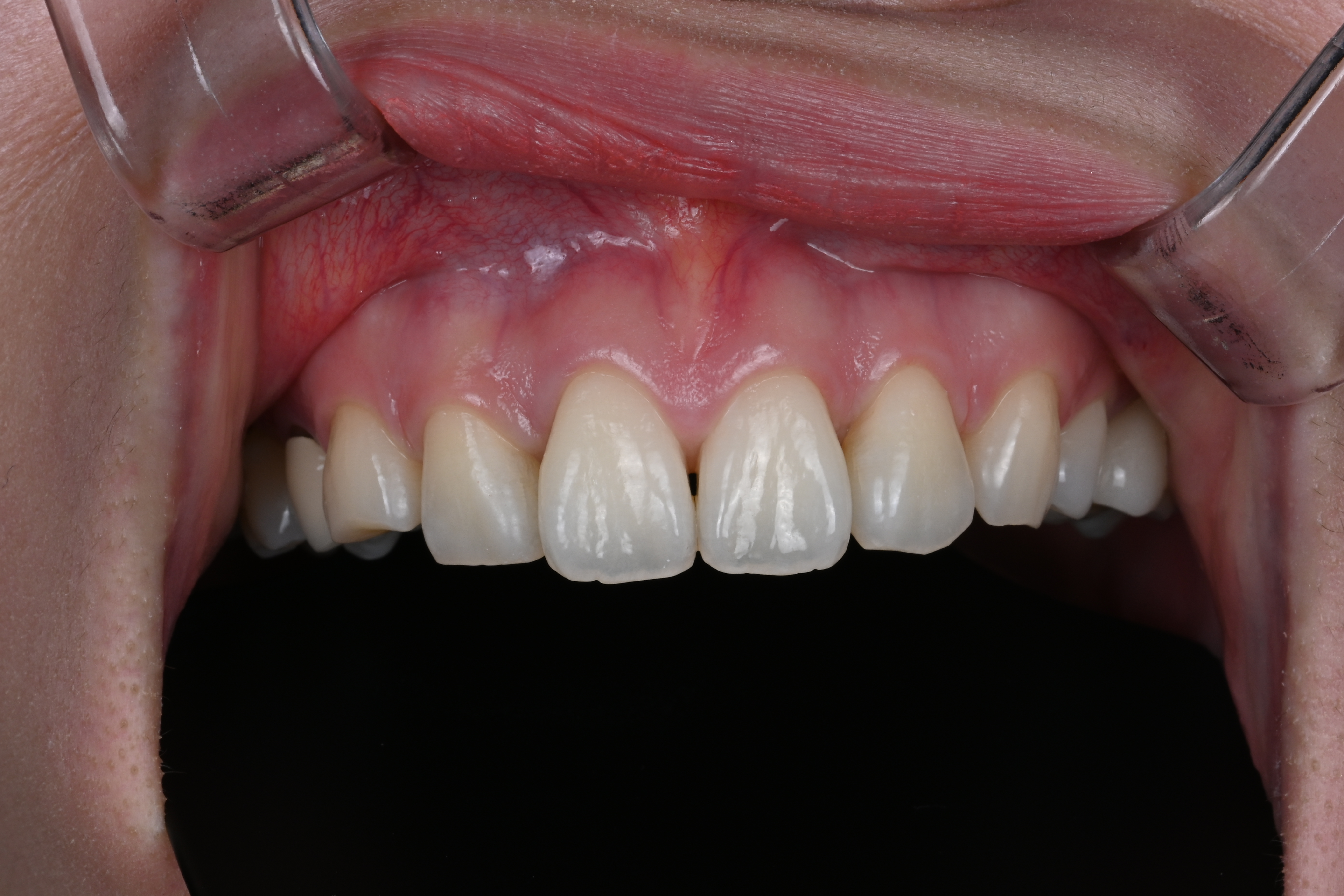 Make Dental case 1 before