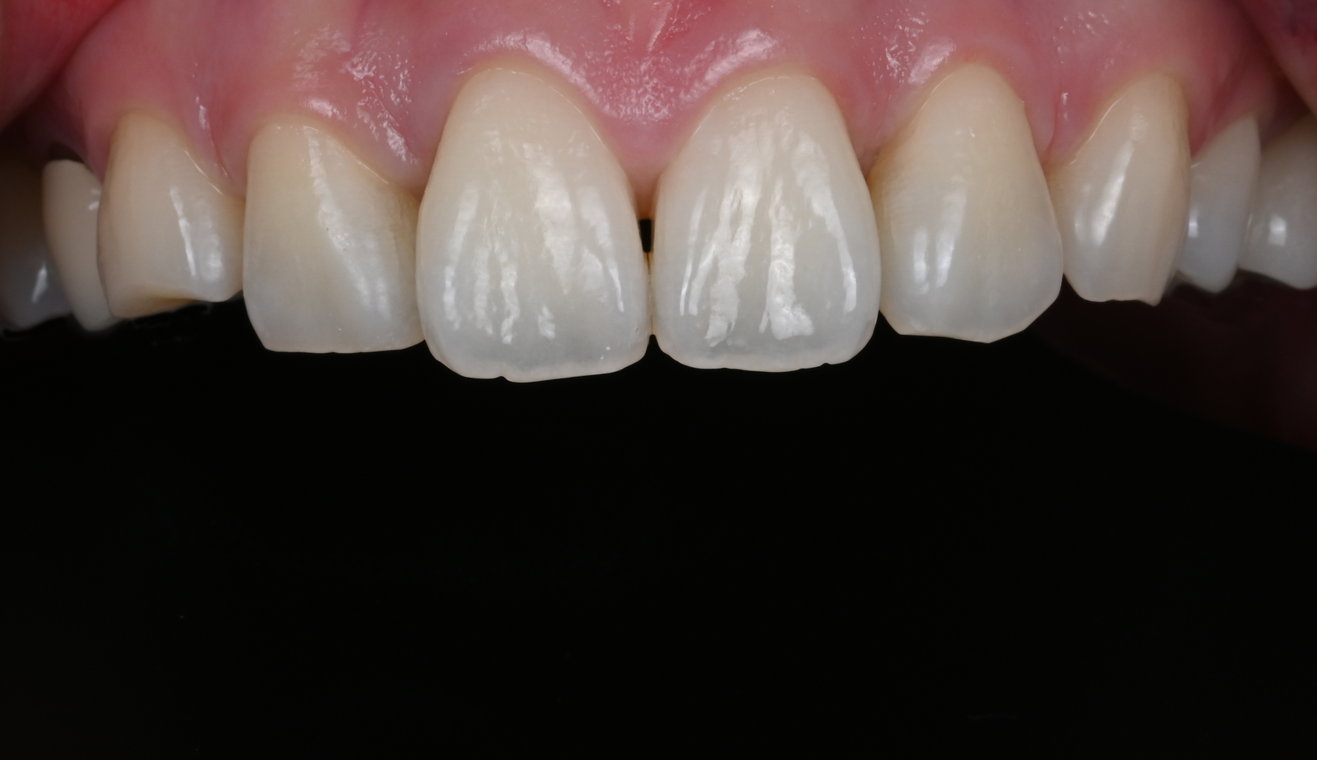 Make Dental case 2 before