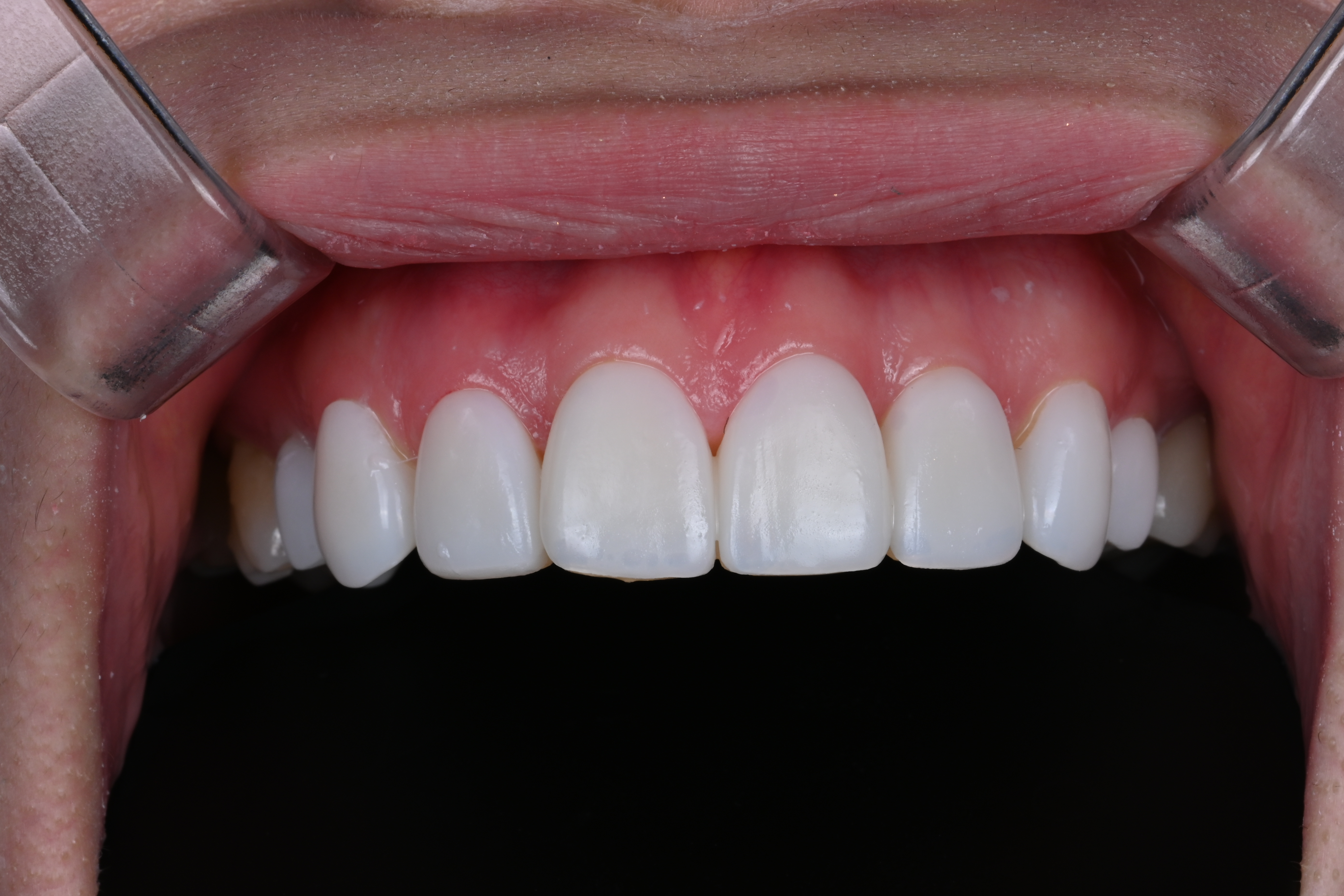 Make Dental case 3 before