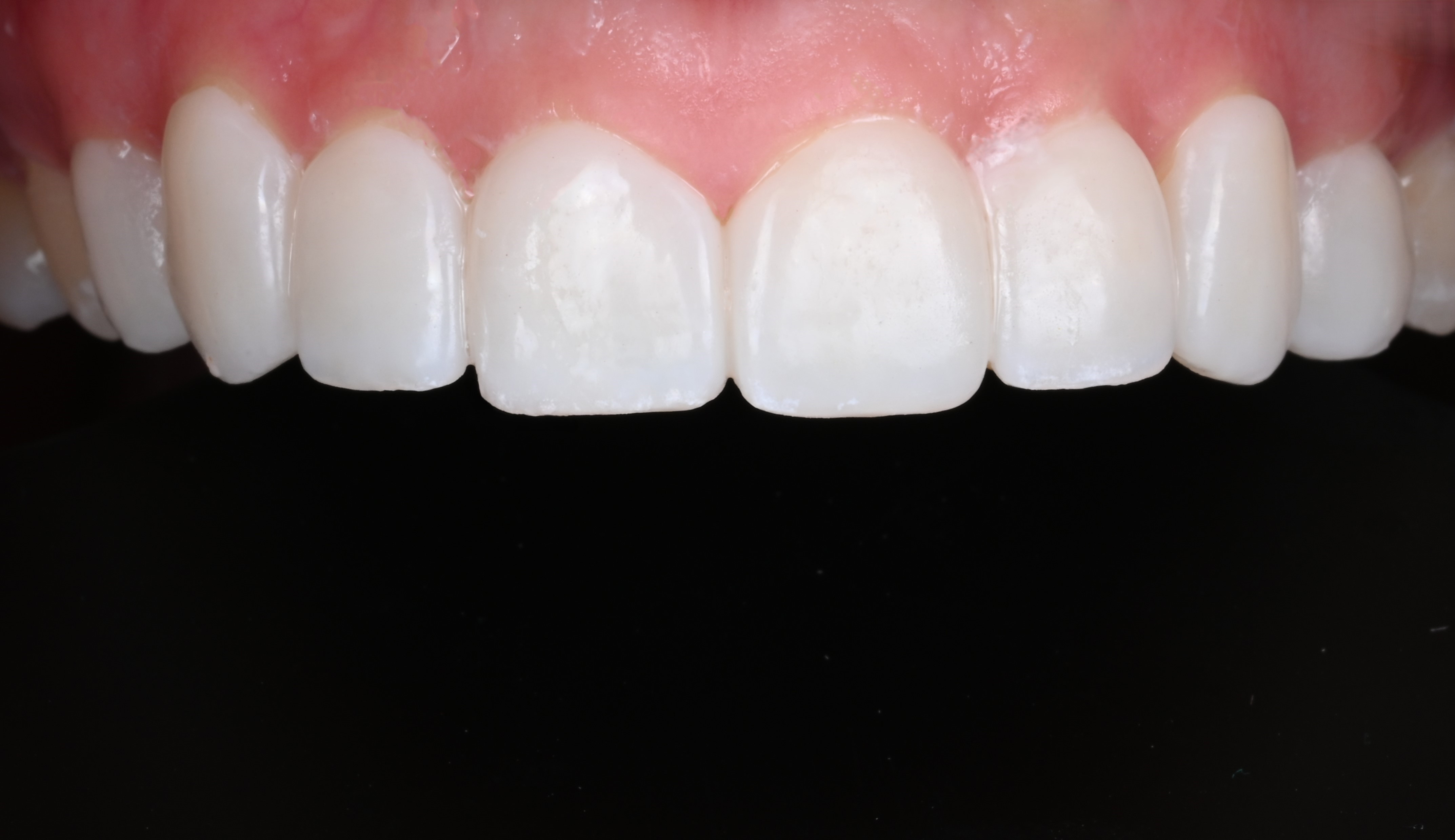 Make Dental case 6 before