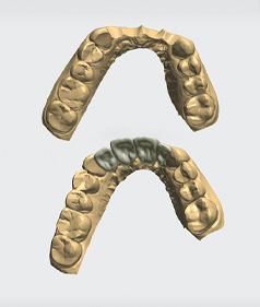 Step 1: Dental prosthesis — pre-design after oral scan