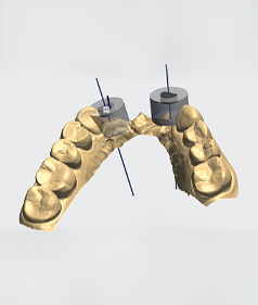 Step 2: Determine implant placement location