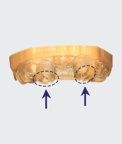 Step 3: 3D printing of the surgical guide