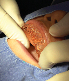 Step 4: Implant placement with the guide