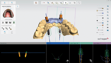 3Shape Implant Studio — digital surgical planning