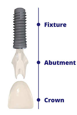 Dental Implant Components