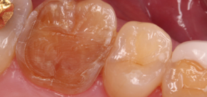 Molar Make Dental Before/After