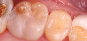 Molar Make Dental Before/After
