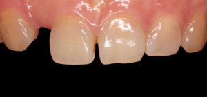 Molar Make Dental Before/After
