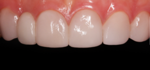 Molar Make Dental Before/After